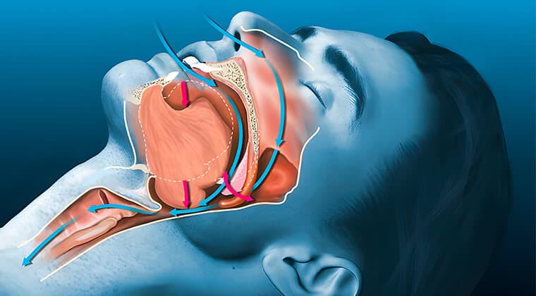Apnea obstructiva del sueño
