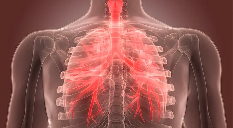Bronquitis crónica