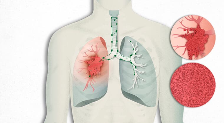 Cáncer de pulmón