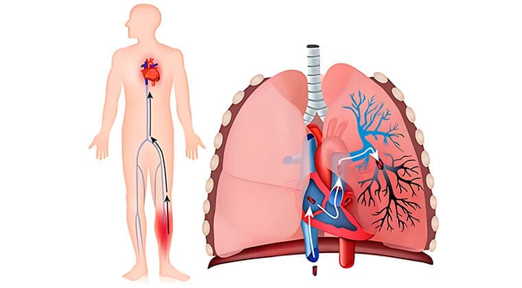 Embolia pulmonar