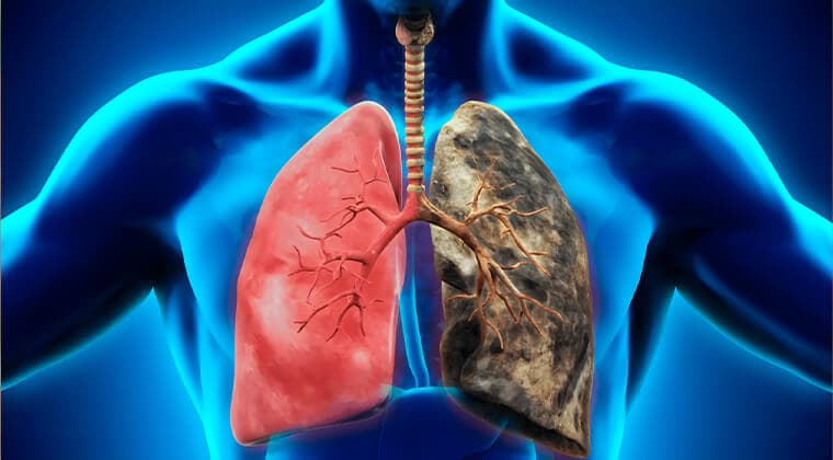 Enfermedad pulmonar obstructiva crónica (EPOC)