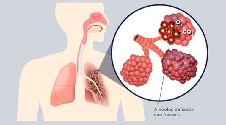 Fibrosis pulmonar