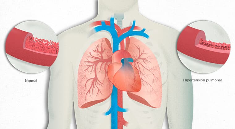 Hipertensión pulmonar