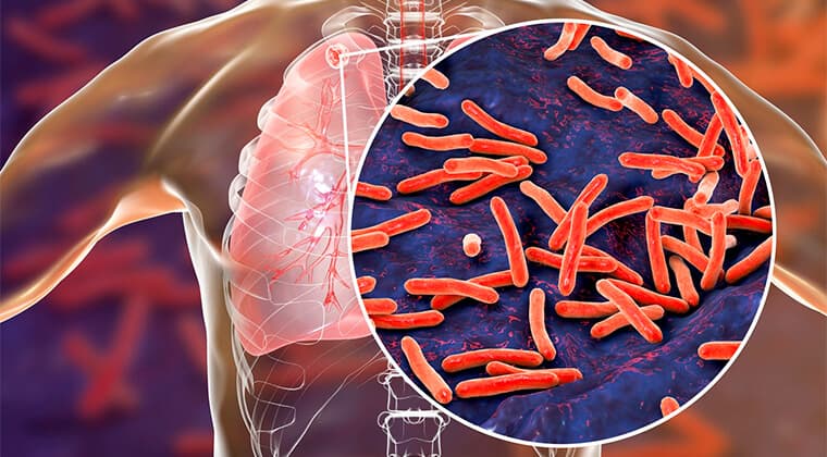 Tuberculosis pulmonar