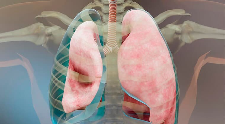 Drenaje y aspiración torácica