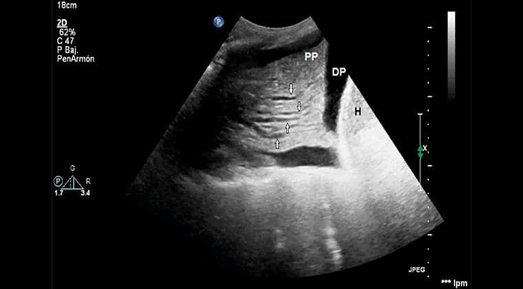 Ultrasonido pulmonar